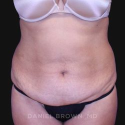 Tummy Tuck Before & After Patient #10702