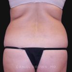Tummy Tuck Before & After Patient #10702
