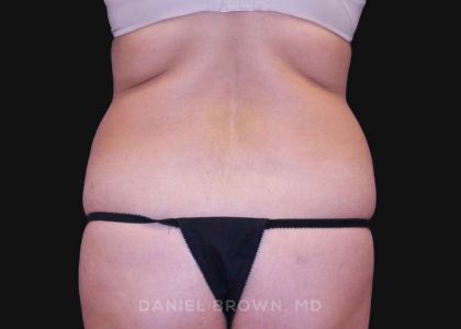Tummy Tuck Before & After Patient #10702