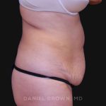 Tummy Tuck Before & After Patient #10702