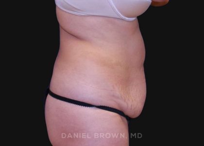 Tummy Tuck Before & After Patient #10702