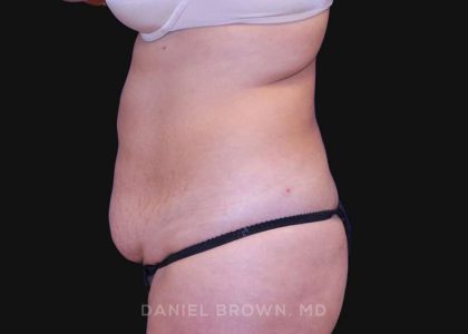 Tummy Tuck Before & After Patient #10702