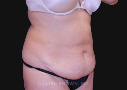 Tummy Tuck Before & After Patient #10702