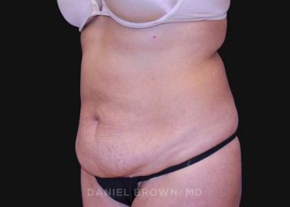 Tummy Tuck Before & After Patient #10702