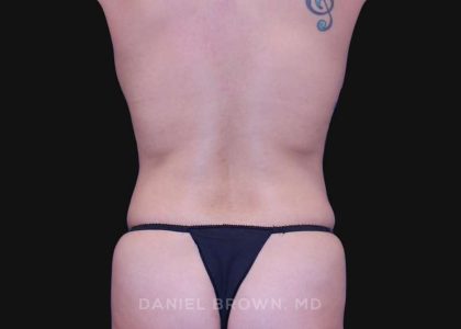 Tummy Tuck Before & After Patient #10715