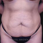 Tummy Tuck Before & After Patient #10715