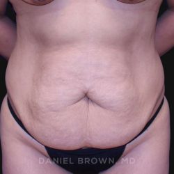 Tummy Tuck Before & After Patient #10715