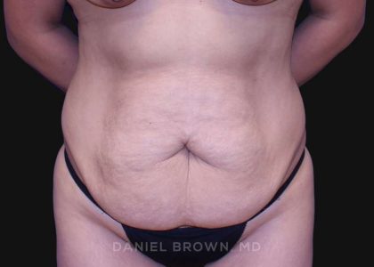 Tummy Tuck Before & After Patient #10715