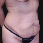 Tummy Tuck Before & After Patient #10715