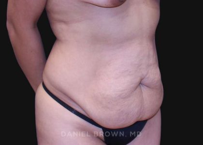 Tummy Tuck Before & After Patient #10715