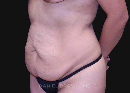 Tummy Tuck Before & After Patient #10715