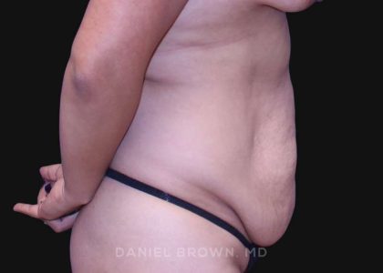 Tummy Tuck Before & After Patient #10715