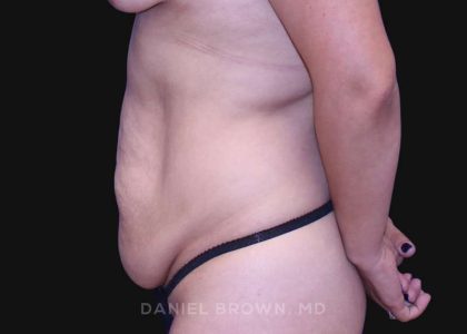 Tummy Tuck Before & After Patient #10715