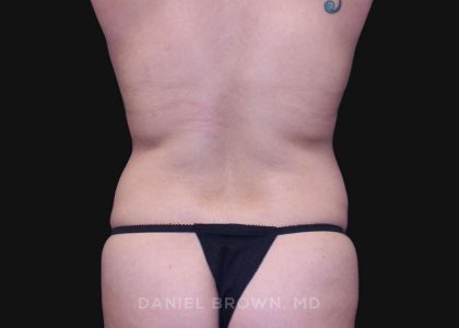 Tummy Tuck Before & After Patient #10715