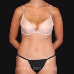 Tummy Tuck Before & After Patient #10726