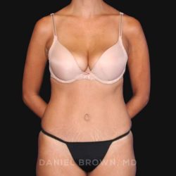Tummy Tuck Before & After Patient #10726
