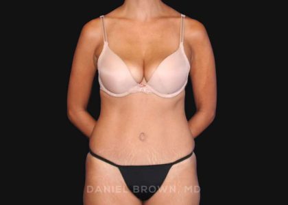 Tummy Tuck Before & After Patient #10726