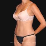 Tummy Tuck Before & After Patient #10726
