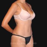 Tummy Tuck Before & After Patient #10726
