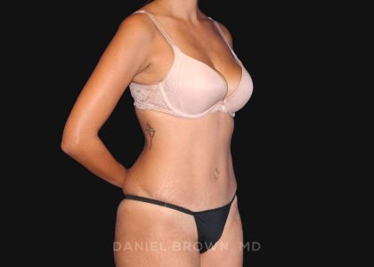 Tummy Tuck Before & After Patient #10726
