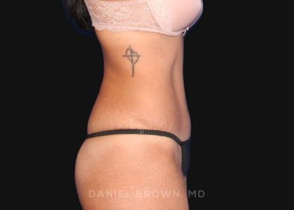 Tummy Tuck Before & After Patient #10726