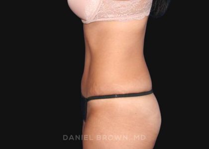 Tummy Tuck Before & After Patient #10726