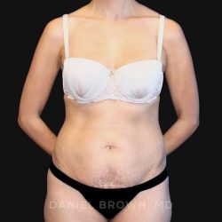 Tummy Tuck Before & After Patient #10726