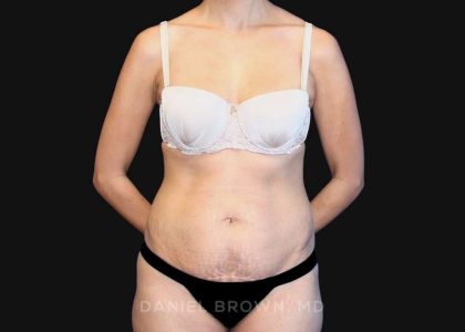 Tummy Tuck Before & After Patient #10726