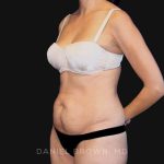 Tummy Tuck Before & After Patient #10726