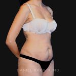 Tummy Tuck Before & After Patient #10726