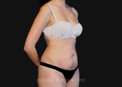 Tummy Tuck Before & After Patient #10726