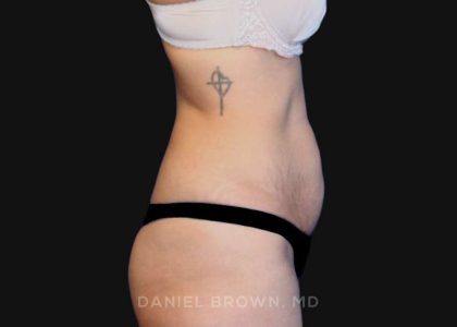 Tummy Tuck Before & After Patient #10726