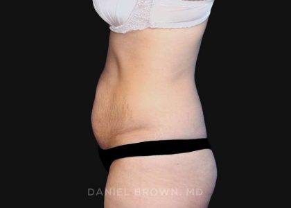 Tummy Tuck Before & After Patient #10726