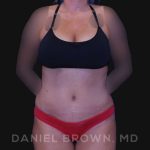 Tummy Tuck Before & After Patient #10737