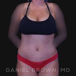 Tummy Tuck Before & After Patient #10737