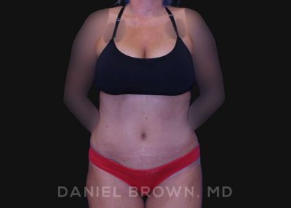 Tummy Tuck Before & After Patient #10737