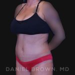 Tummy Tuck Before & After Patient #10737