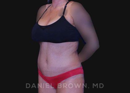 Tummy Tuck Before & After Patient #10737