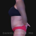 Tummy Tuck Before & After Patient #10737