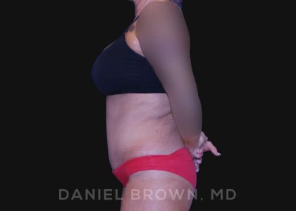 Tummy Tuck Before & After Patient #10737