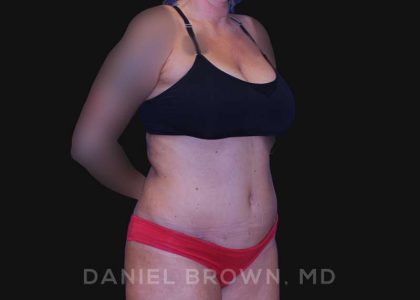 Tummy Tuck Before & After Patient #10737