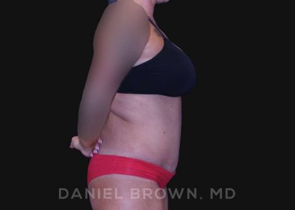Tummy Tuck Before & After Patient #10737