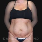 Tummy Tuck Before & After Patient #10737