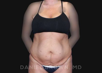 Tummy Tuck Before & After Patient #10737