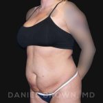Tummy Tuck Before & After Patient #10737