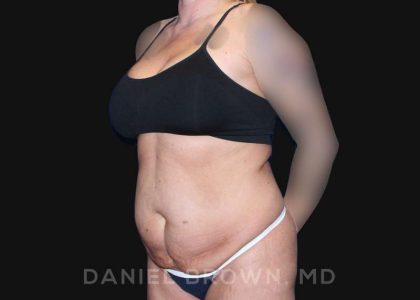 Tummy Tuck Before & After Patient #10737