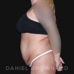 Tummy Tuck Before & After Patient #10737