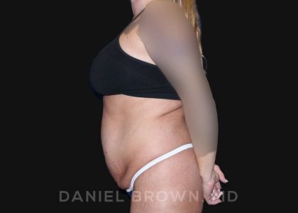 Tummy Tuck Before & After Patient #10737