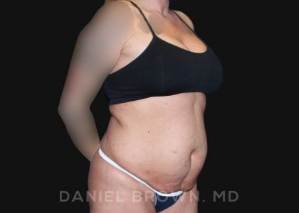 Tummy Tuck Before & After Patient #10737