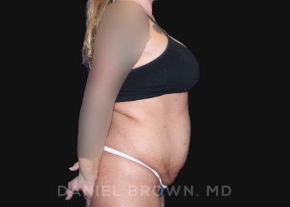 Tummy Tuck Before & After Patient #10737